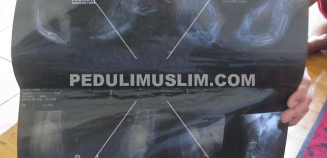 (Foto: Gambar hasil Rontgen)