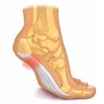 Fascitis-Plantar